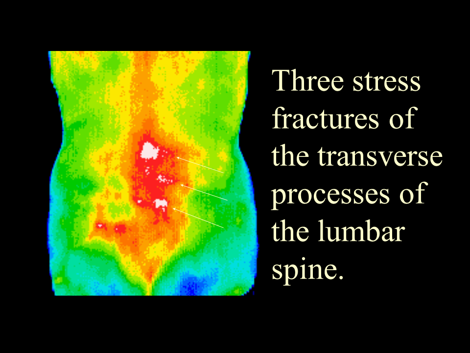 15 Lumbar stress fractures