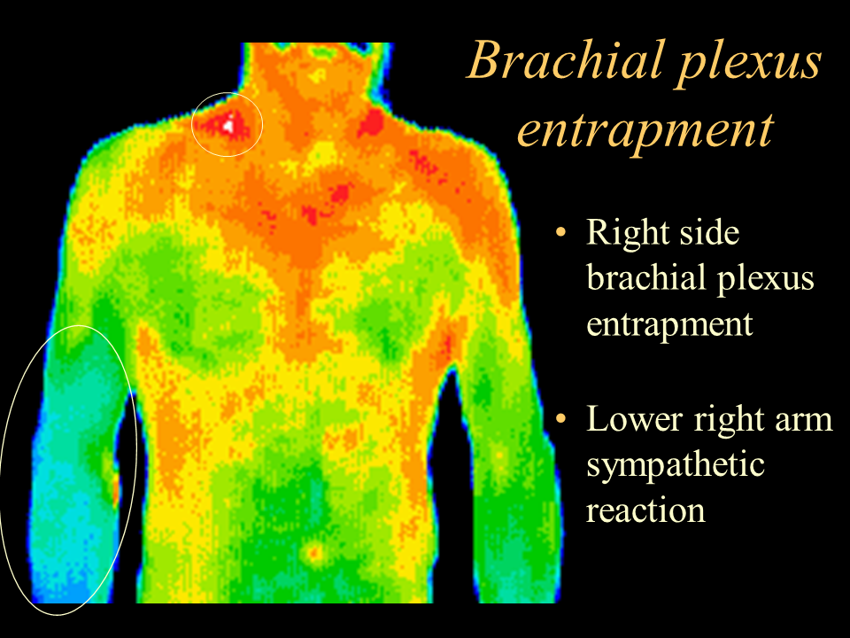 24 Brachial entrapment