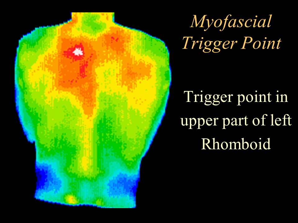 39 Rhomboid trigger point