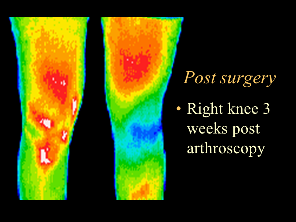 40 post knee arthroscopy