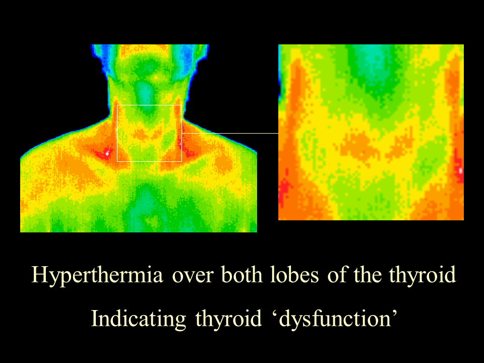 6 Thyroid